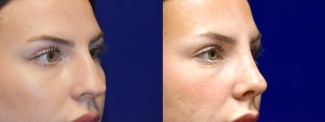 Right 3/4 View - Rhinoplasty 