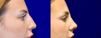 Right Profile View - Rhinoplasty 