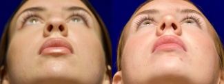 Frontal Low Angle View - Rhinoplasty