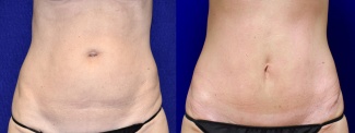 Frontal View - Tummy Tuck