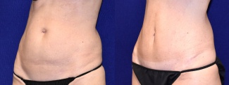 Left 3/4 View - Tummy Tuck