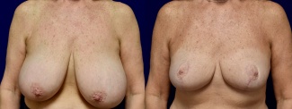 Frontal View - Breast Reduction