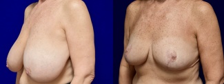 Left 3/4 View - Breast Reduction