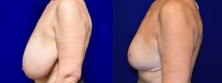 Left Profile View - Breast Reduction