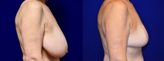 Right Profile View - Breast Reduction