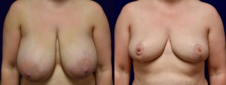 Frontal View - Breast Reduction