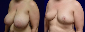 Left 3/4 View - Breast Reduction
