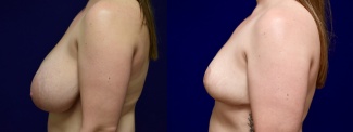 Left Profile View - Breast Reduction