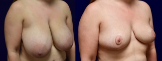 Right 3/4 View - Breast Reduction