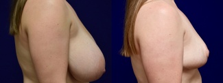 Right Profile View - Breast Reduction