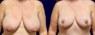 Frontal View - Breast Reduction