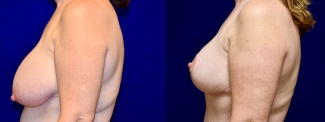 Left Profile View - Breast Reduction