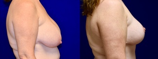 Right Profile View - Breast Reduction