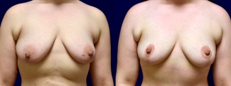 Frontal View - Breast Lift After Weight Loss