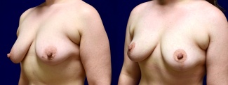 Left 3/4 View - Breast Lift After Weight Loss