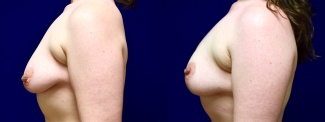 Left Profile View - Breast Lift After Weight Loss