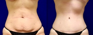 Frontal View - Tummy Tuck After Weight Loss