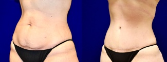 Left 3/4 View - Tummy Tuck After Weight Loss