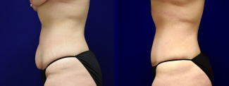 Left Profile View - Tummy Tuck After Weight Loss