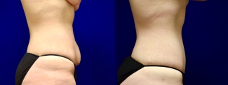 Right Profile View - Tummy Tuck After Weight Loss