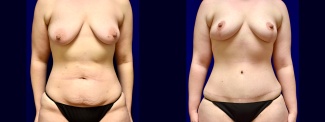 Frontal View - Breast Lift and Tummy Tuck After Weight Loss