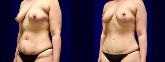 Left 3/4 View - Breast Lift and Tummy Tuck After Weight Loss