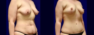 Right 3/4 View - Breast Lift and Tummy Tuck After Weight Loss