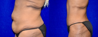 Left Profile View - Tummy Tuck After Weight Loss