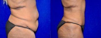 Right Profile View - Tummy Tuck After Weight Loss
