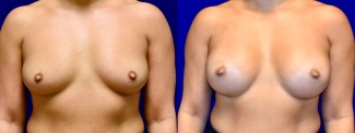 Frontal View - Breast Augmentation