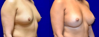 Right 3/4 View - Breast Augmentation