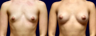 Frontal View - Breast Augmentation
