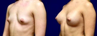 Left 3/4 View - Breast Augmentation