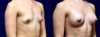 Right 3/4 View - Breast Augmentation