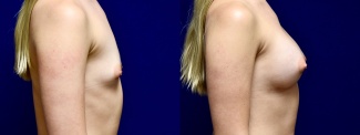 Right Profile View - Breast Augmentation