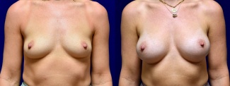 Frontal View - Breast Augmentation