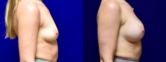 Right Profile View - Breast Augmentation