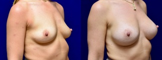 Right 3/4 View - Breast Augmentation