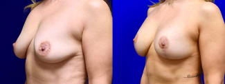 Left 3/4 View - Breast Augmentation with Breast Lift