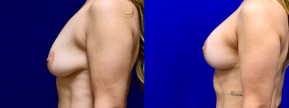 Left Profile View - Breast Augmentation with Breast Lift