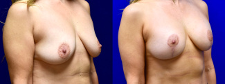 Right 3/4 View - Breast Augmentation with Breast Lift