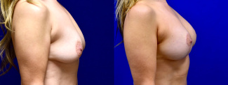 Right Profile View - Breast Augmentation with Breast Lift