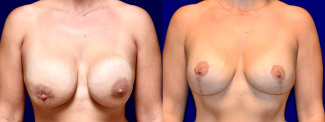 Frontal View - Breast Implant Revision with Breast Lift