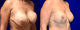 Right 3/4 View - Breast Implant Revision with Breast Lift
