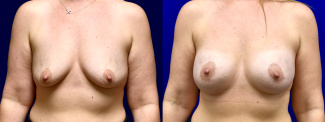 Frontal View - Breast Augmentation with Breast Lift