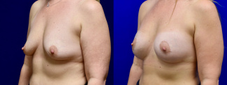 Left 3/4 View - Breast Augmentation with Breast Lift