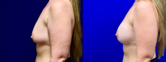 Left Profile View - Breast Augmentation with Breast Lift