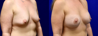 Right 3/4 View - Breast Augmentation with Breast Lift