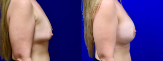 Right Profile View - Breast Augmentation with Breast Lift