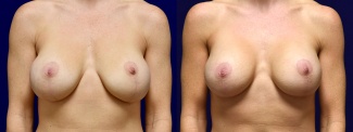 Frontal View - Breast Implant Revision with Galaflex